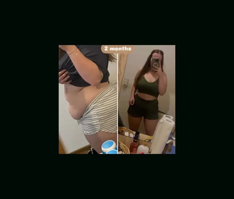ali-acar-md-gastric-sleeve-before-after-1