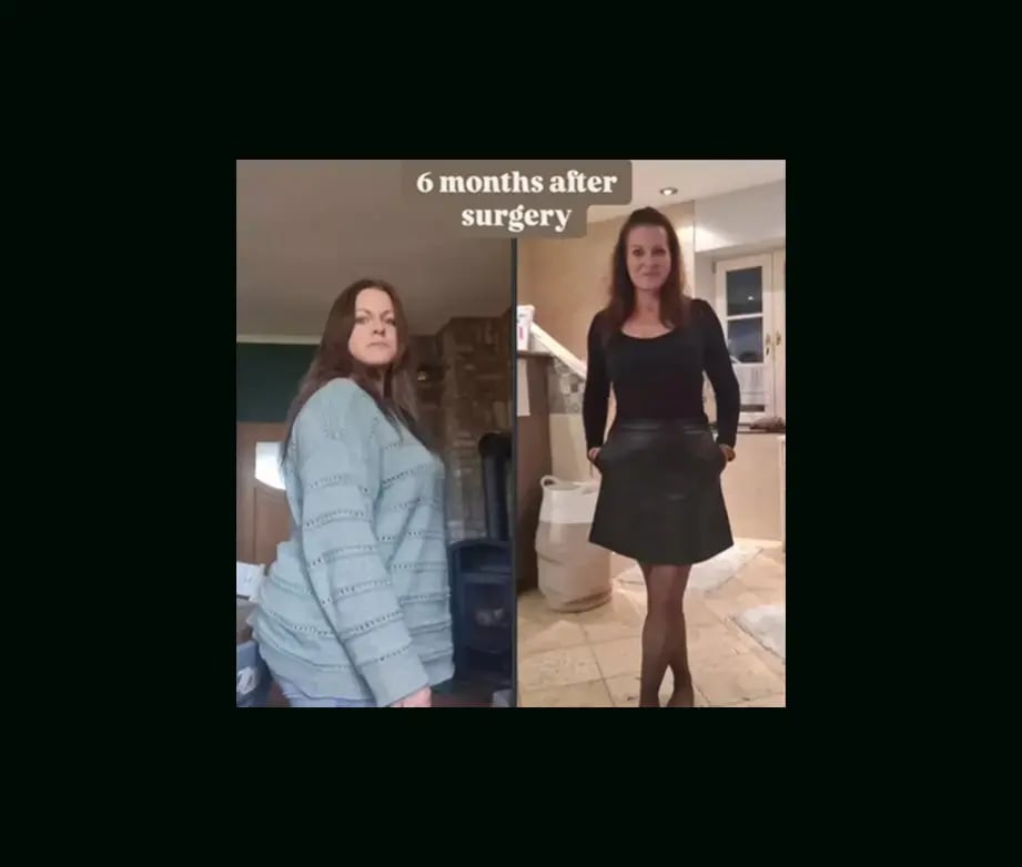 ali-acar-md-gastric-sleeve-before-after-2