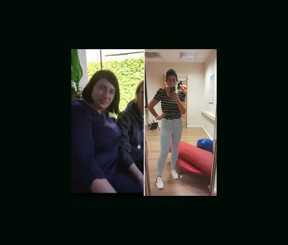 ali-acar-md-gastric-sleeve-before-after-3