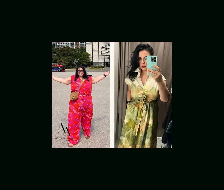 ali-acar-md-gastric-sleeve-before-after-4