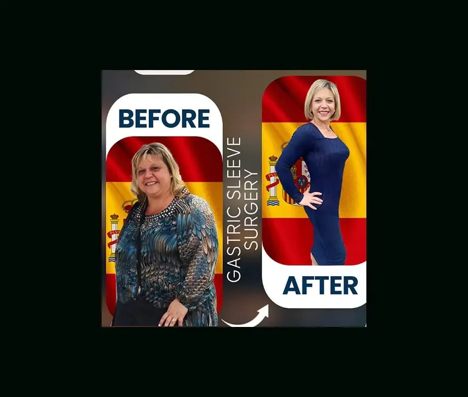 apera-gastric-sleeve-before-after-1