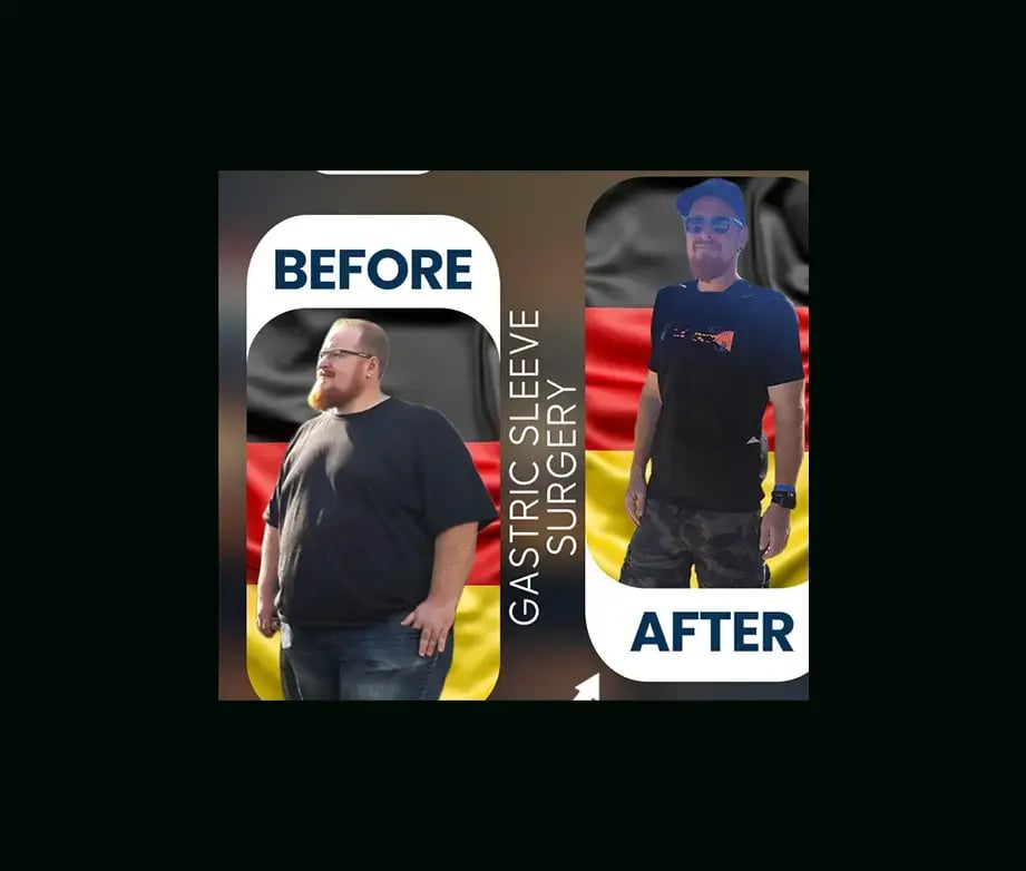 apera-gastric-sleeve-before-after-10