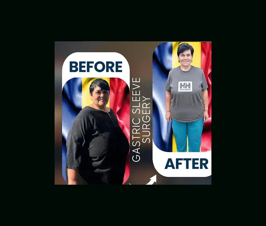 apera-gastric-sleeve-before-after-11