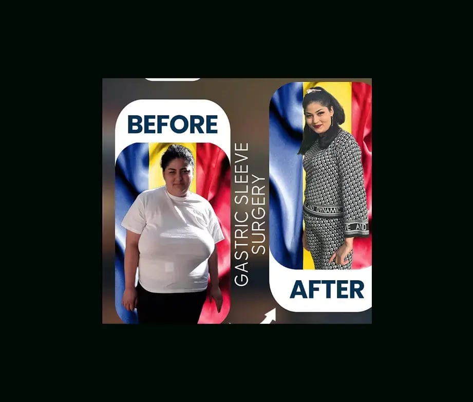apera-gastric-sleeve-before-after-12