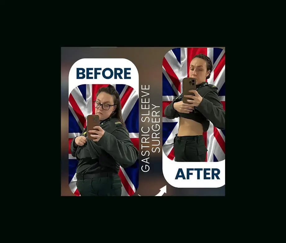 apera-gastric-sleeve-before-after-13