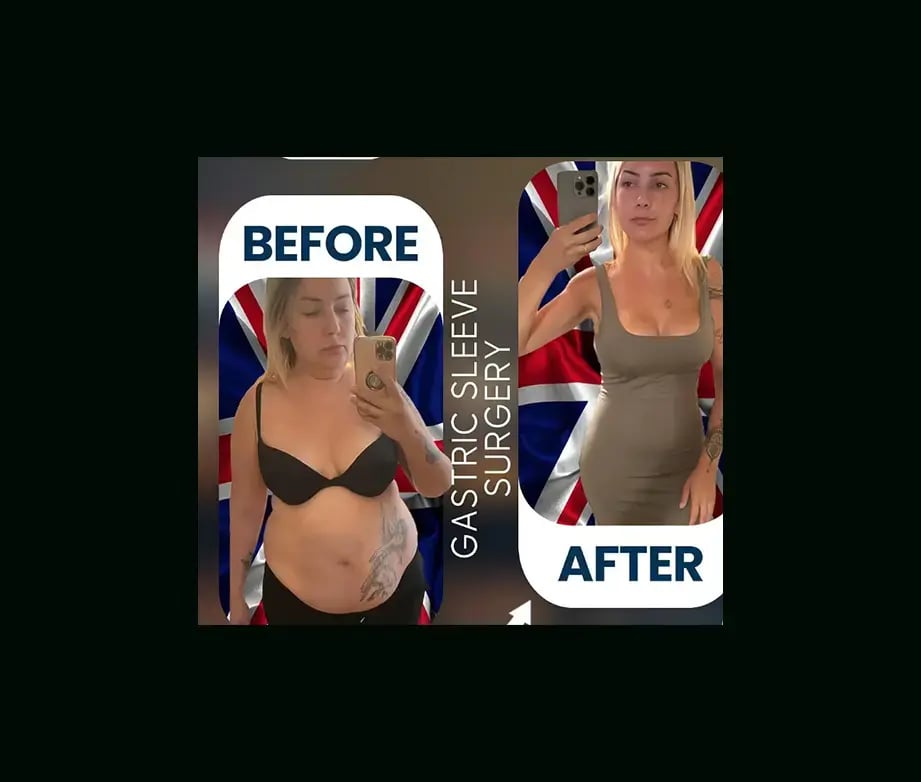 apera-gastric-sleeve-before-after-14