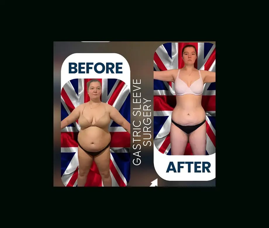 apera-gastric-sleeve-before-after-15
