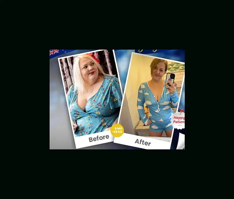 apera-gastric-sleeve-before-after-16