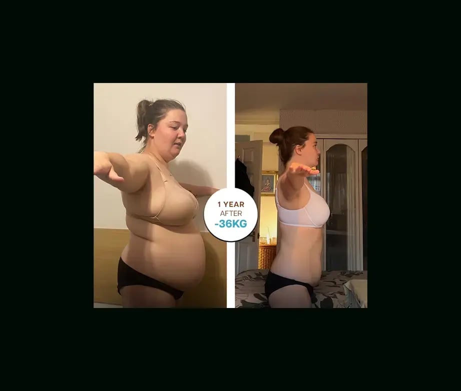 apera-gastric-sleeve-before-after-17