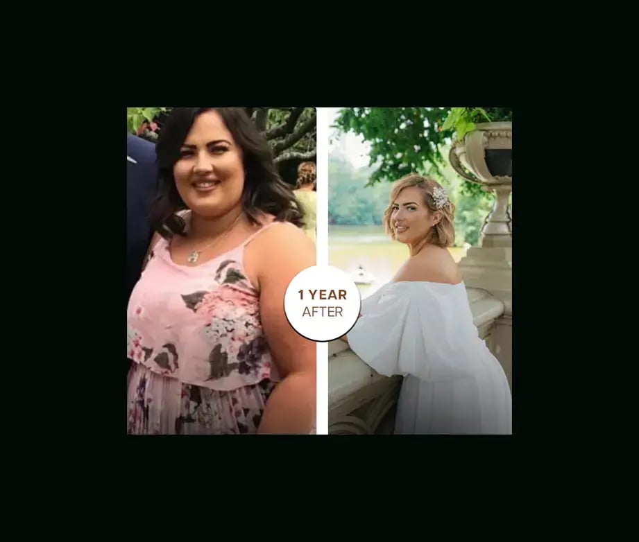 apera-gastric-sleeve-before-after-18