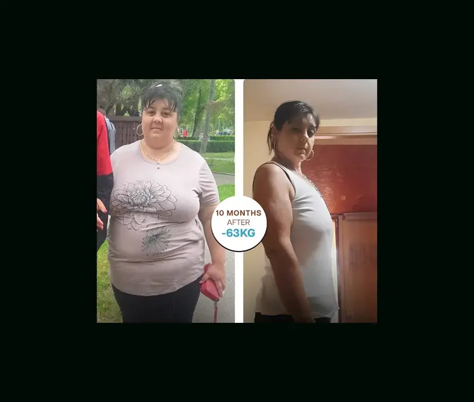apera-gastric-sleeve-before-after-19
