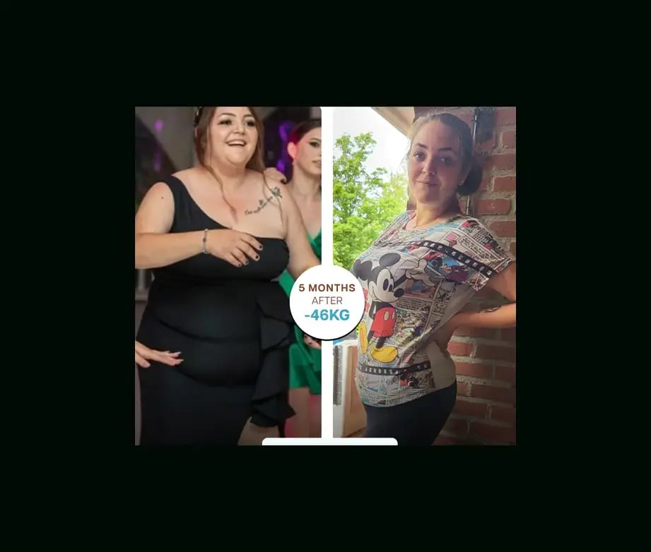 apera-gastric-sleeve-before-after-20