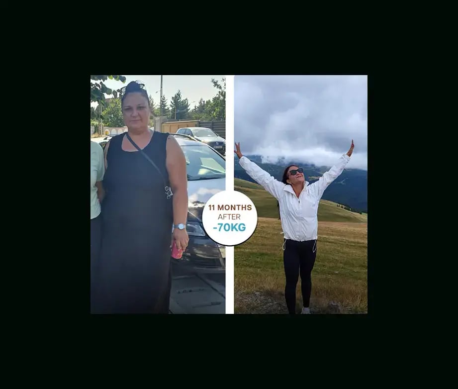 apera-gastric-sleeve-before-after-21