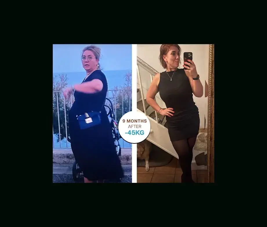apera-gastric-sleeve-before-after-22