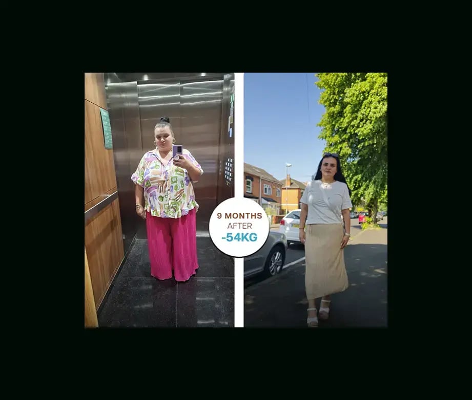 apera-gastric-sleeve-before-after-23