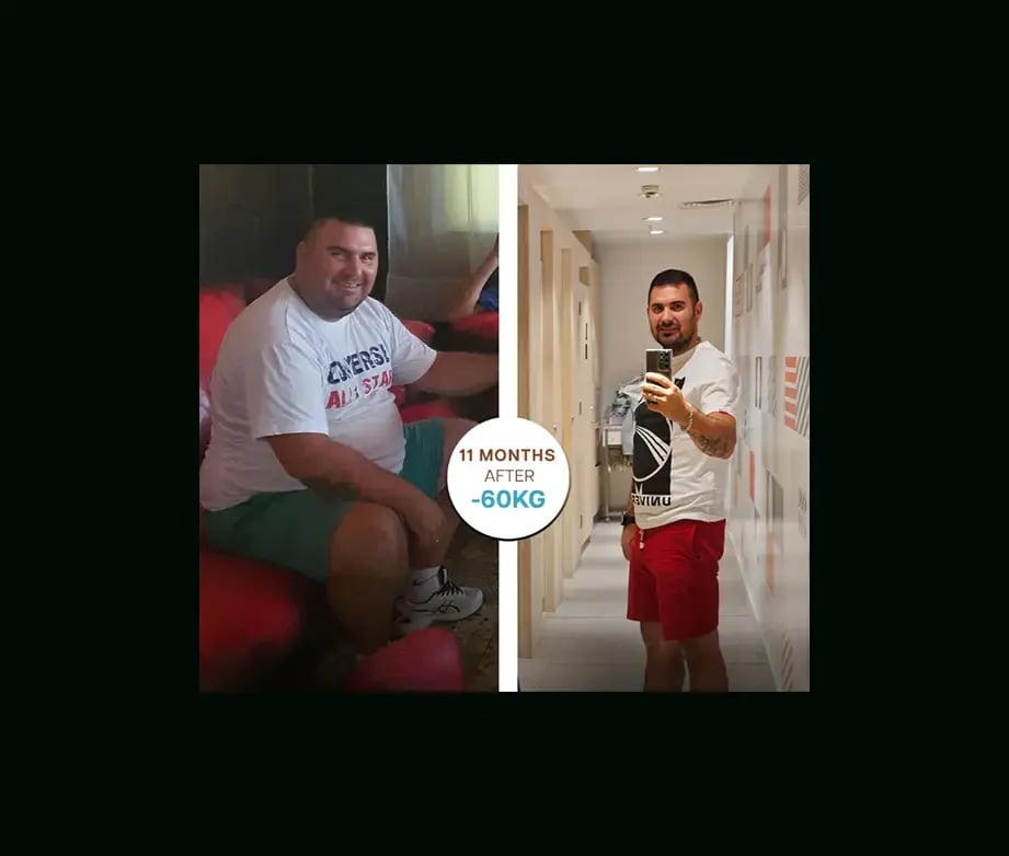 apera-gastric-sleeve-before-after-24