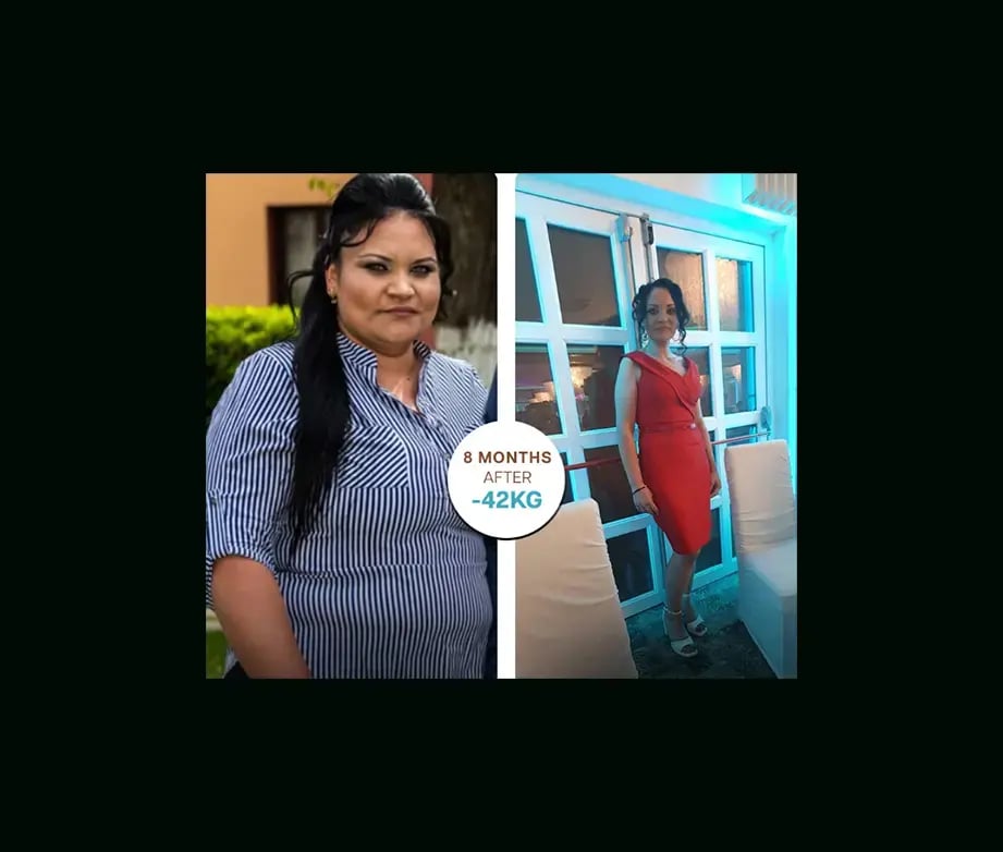apera-gastric-sleeve-before-after-25