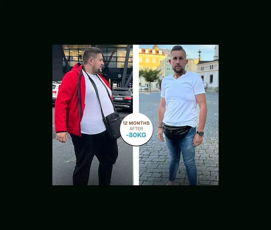 apera-gastric-sleeve-before-after-26