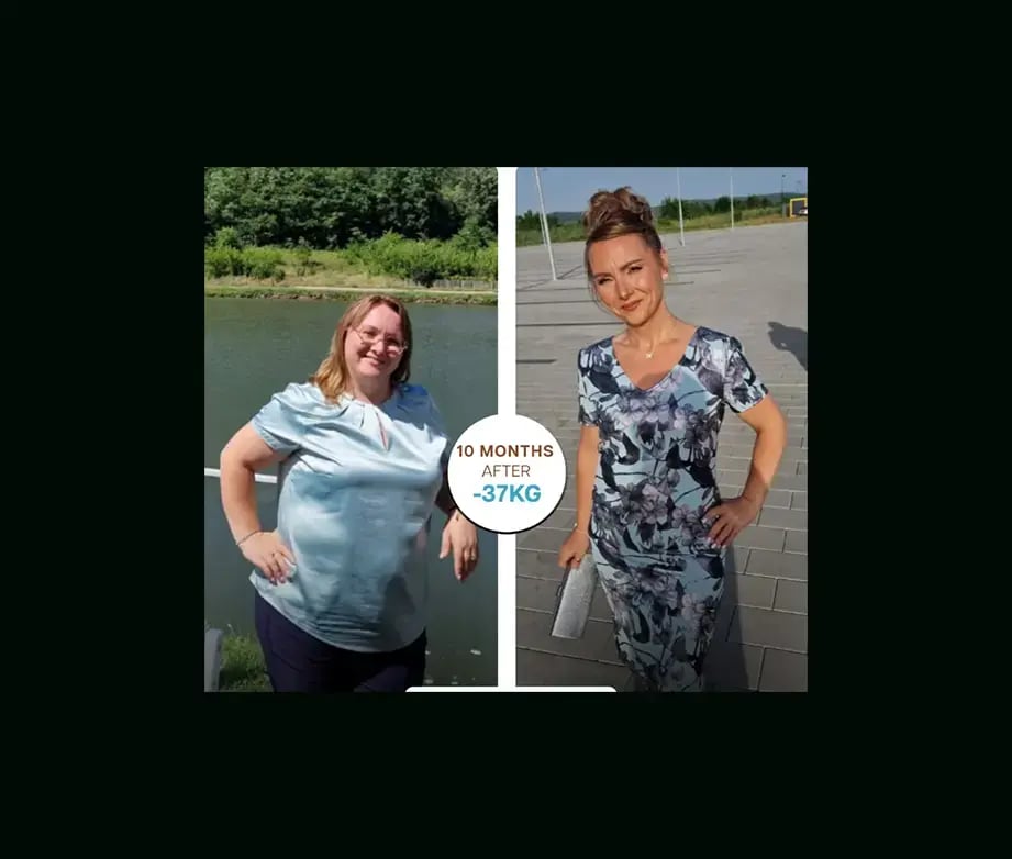 apera-gastric-sleeve-before-after-27