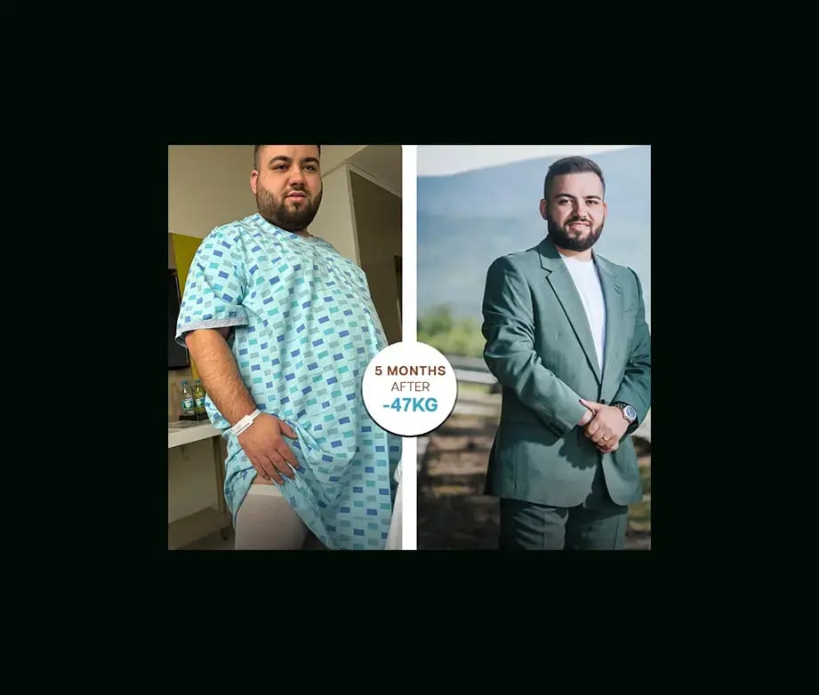 apera-gastric-sleeve-before-after-29