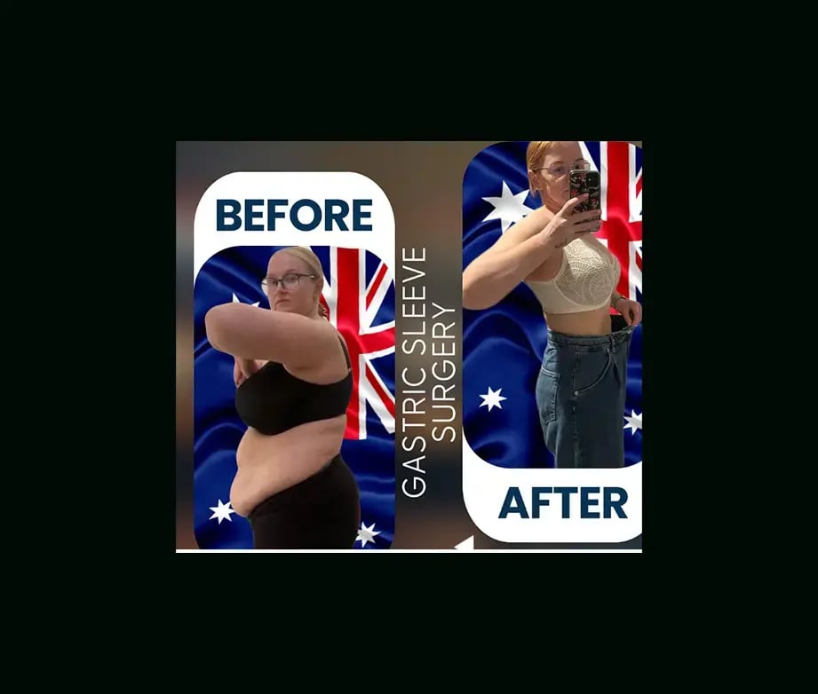 apera-gastric-sleeve-before-after-3