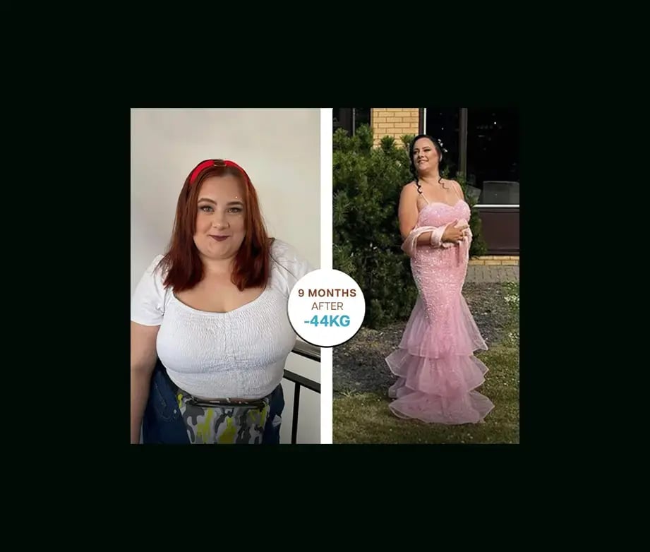apera-gastric-sleeve-before-after-30