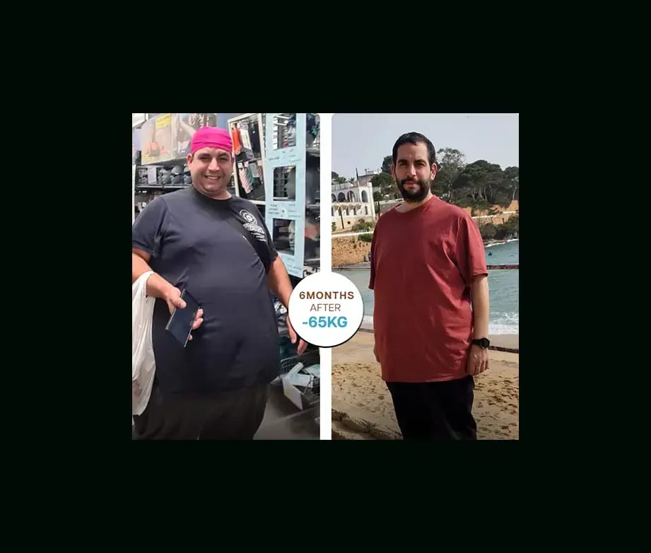 apera-gastric-sleeve-before-after-31