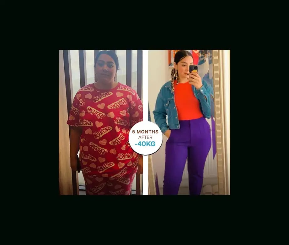 apera-gastric-sleeve-before-after-32