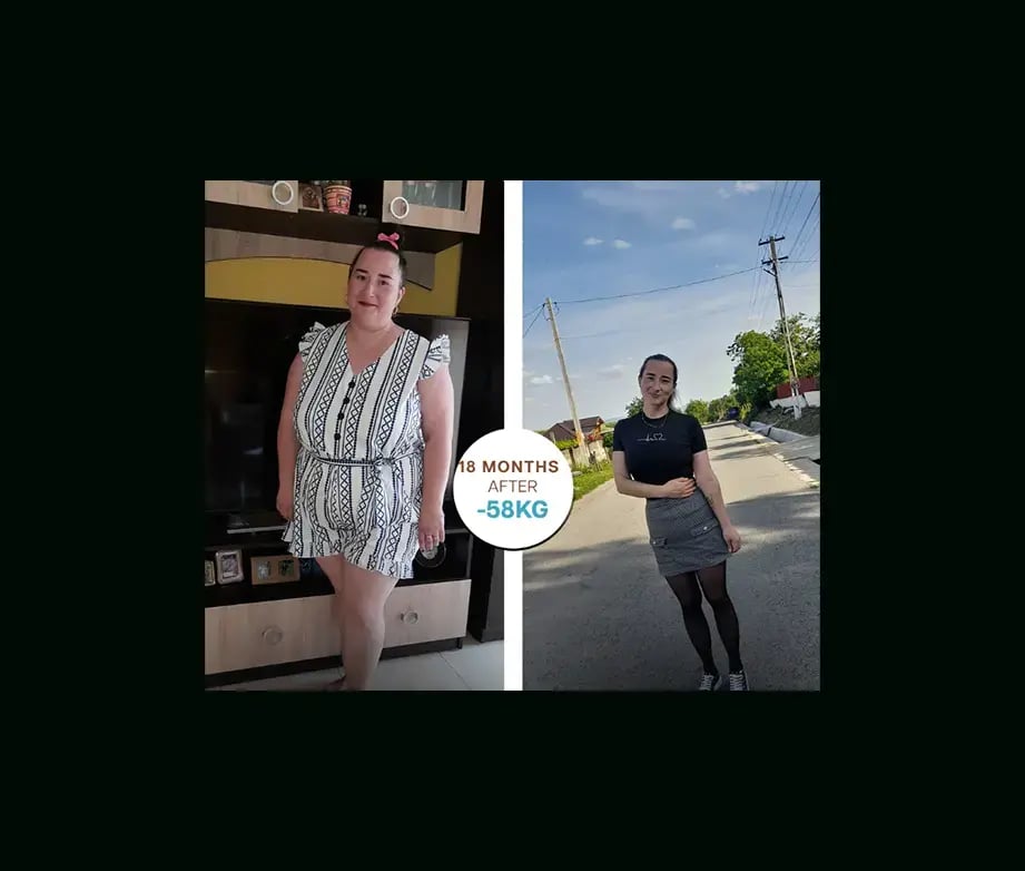 apera-gastric-sleeve-before-after-33