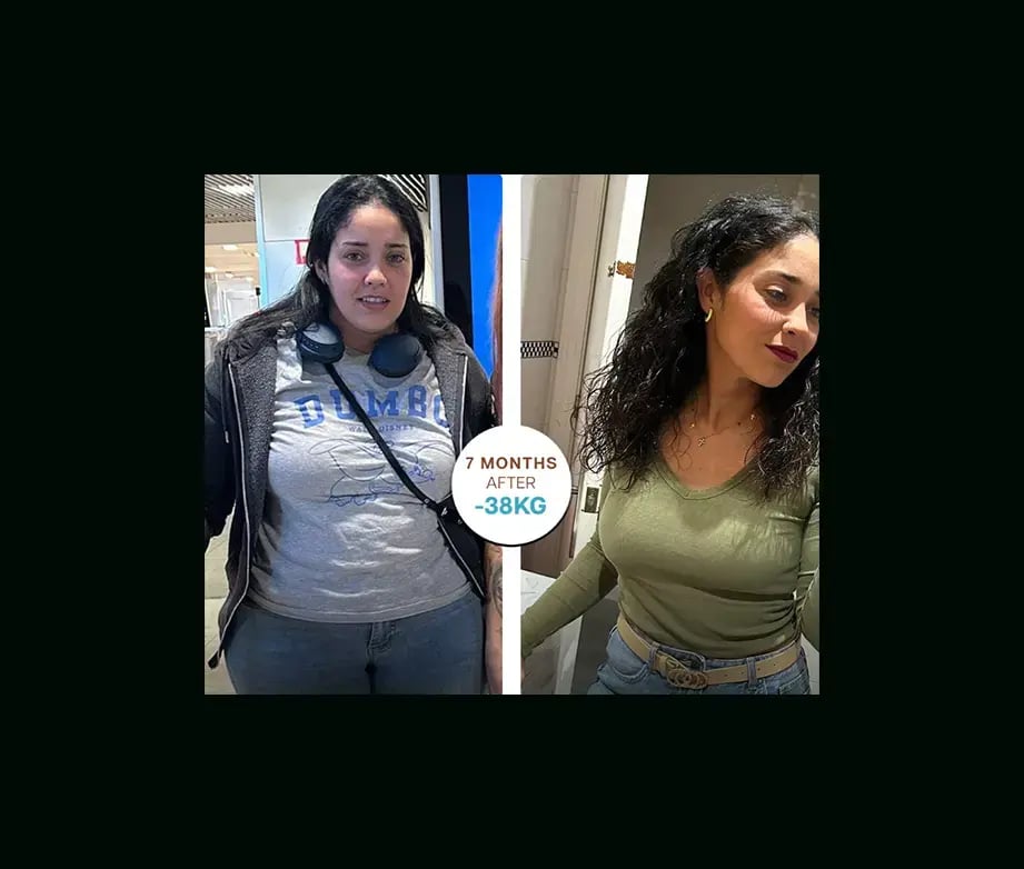 apera-gastric-sleeve-before-after-34