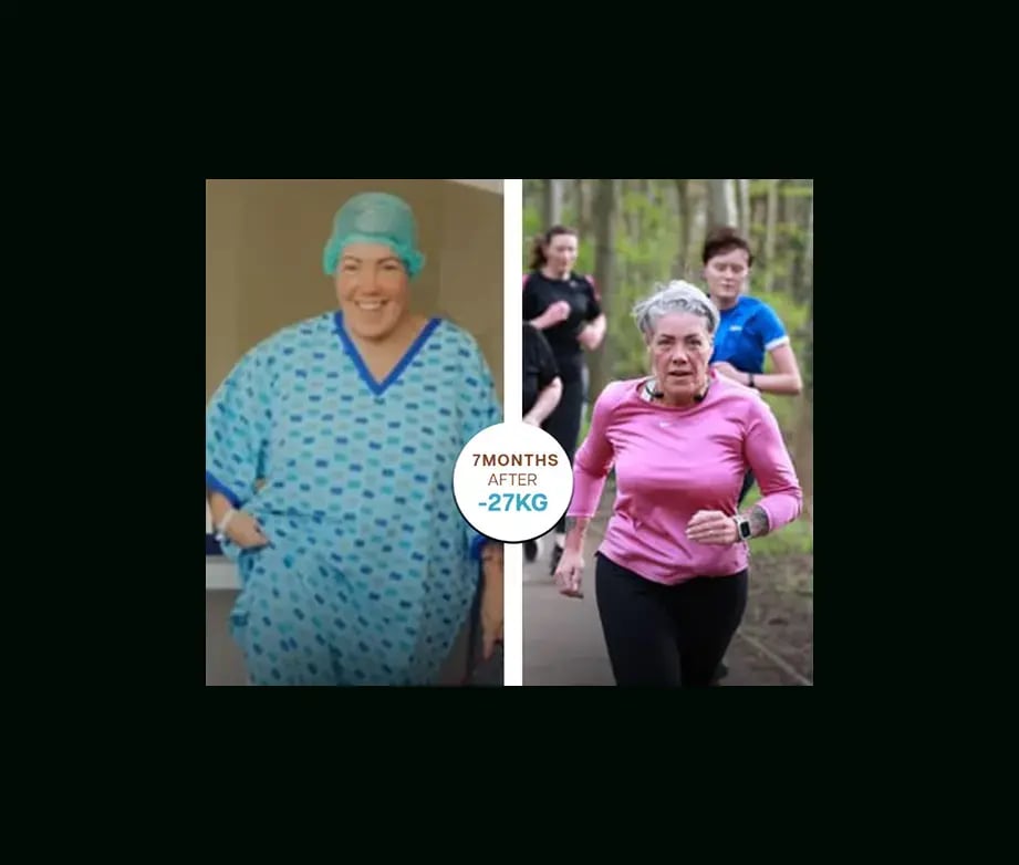 apera-gastric-sleeve-before-after-35