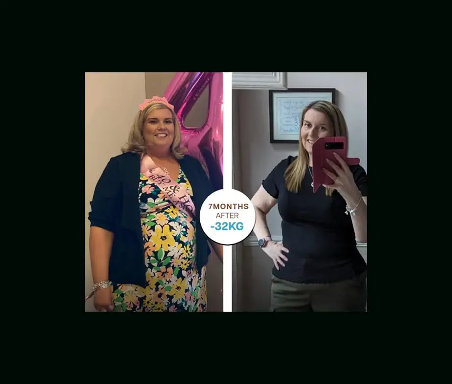 apera-gastric-sleeve-before-after-36