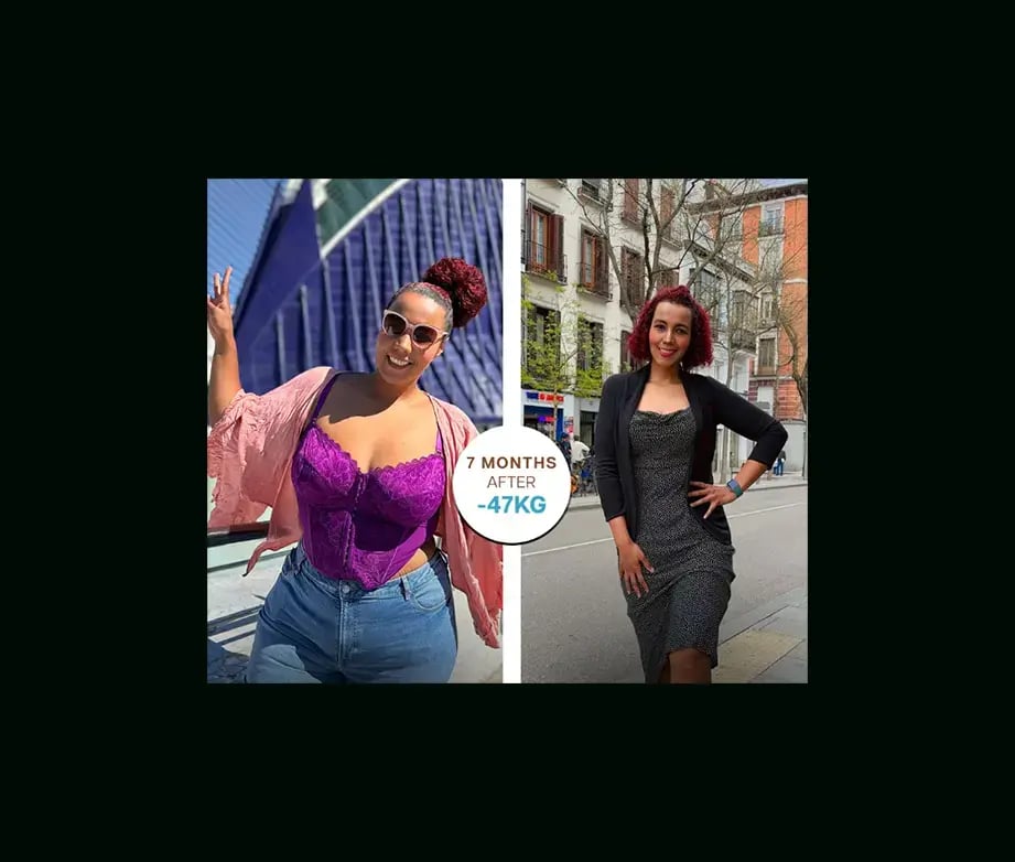 apera-gastric-sleeve-before-after-37