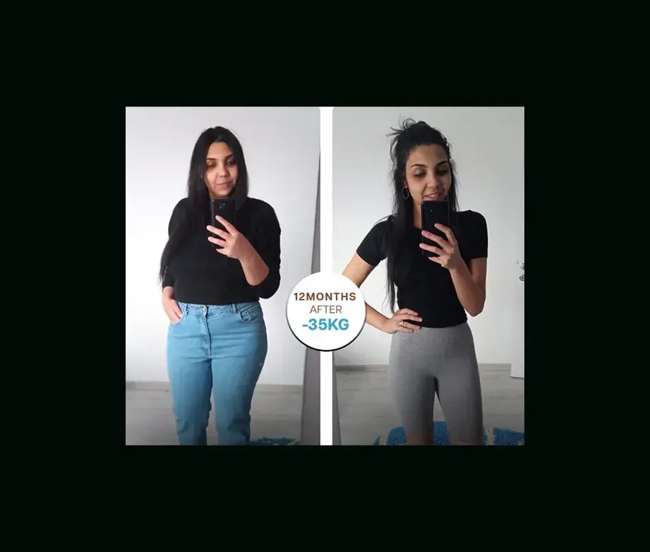 apera-gastric-sleeve-before-after-38