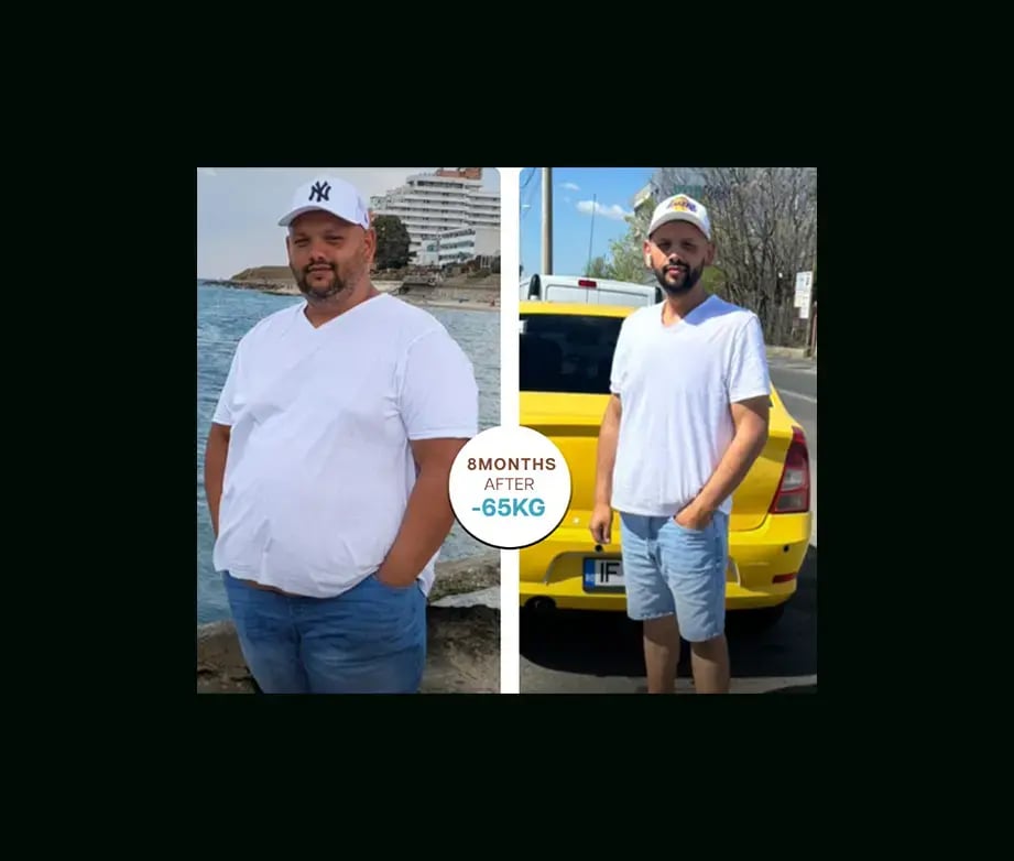 apera-gastric-sleeve-before-after-39