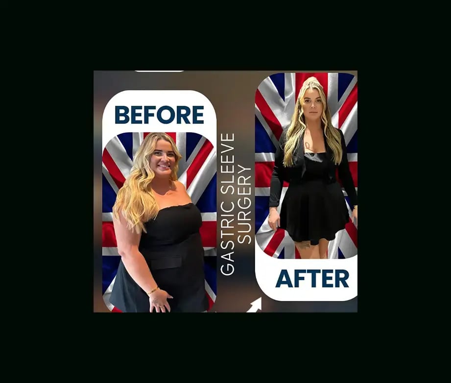 apera-gastric-sleeve-before-after-4