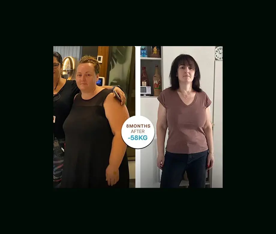 apera-gastric-sleeve-before-after-40