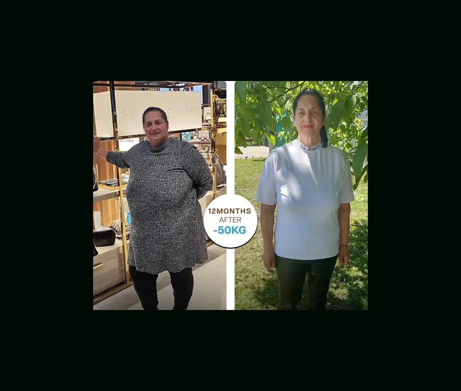 apera-gastric-sleeve-before-after-41