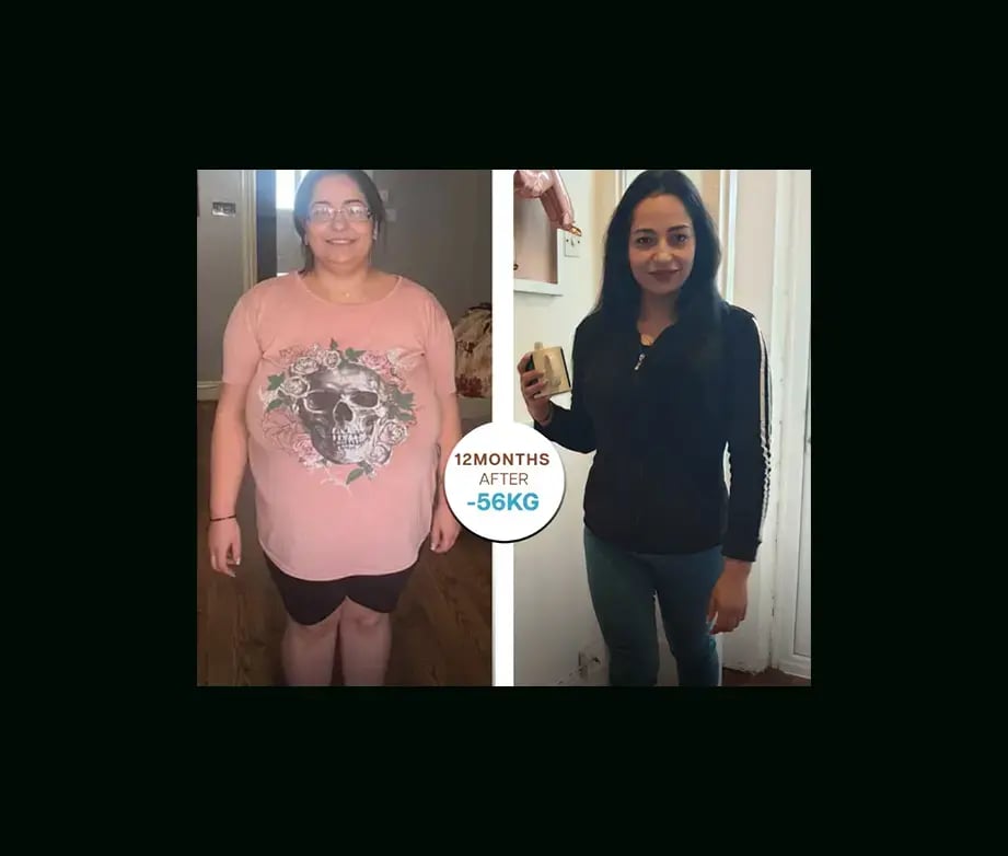 apera-gastric-sleeve-before-after-42