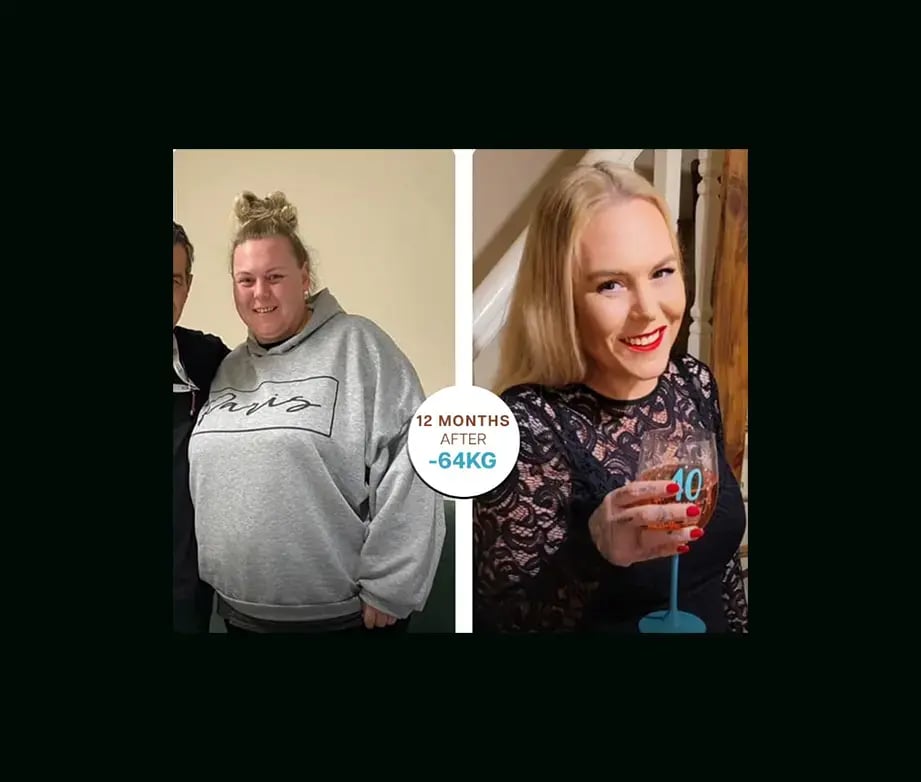 apera-gastric-sleeve-before-after-43