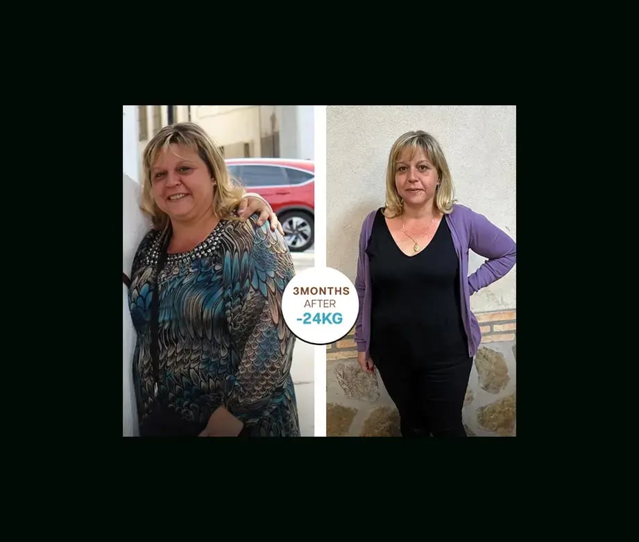 apera-gastric-sleeve-before-after-44