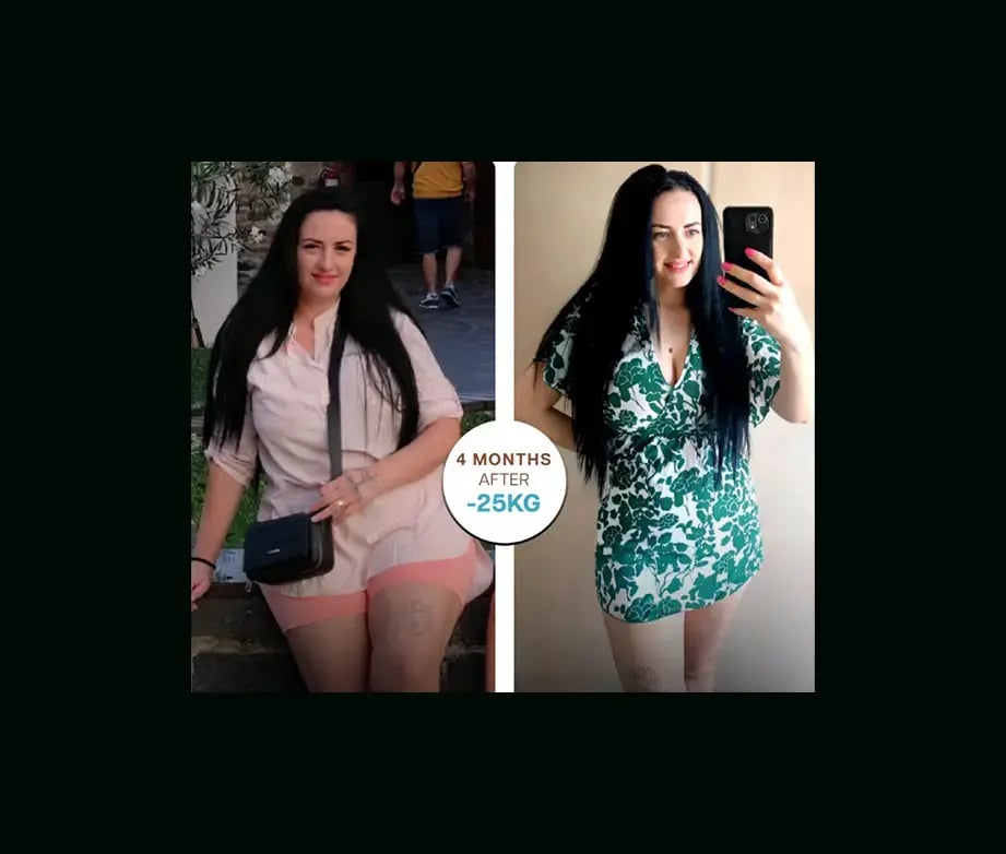 apera-gastric-sleeve-before-after-45