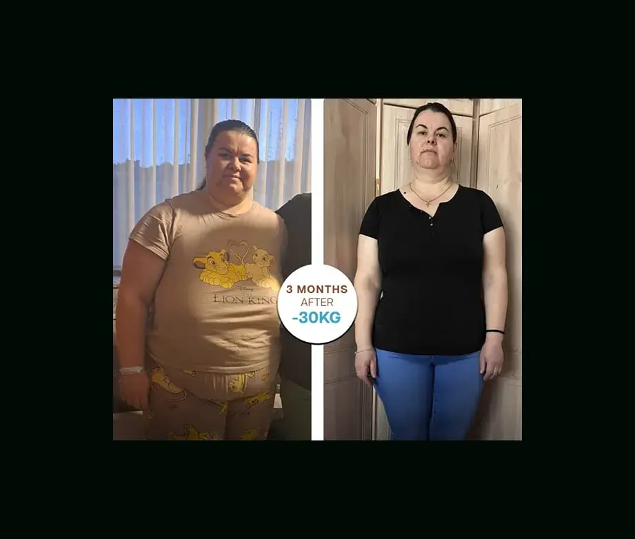 apera-gastric-sleeve-before-after-46