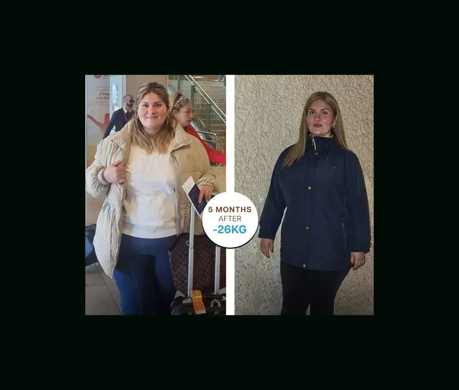 apera-gastric-sleeve-before-after-47