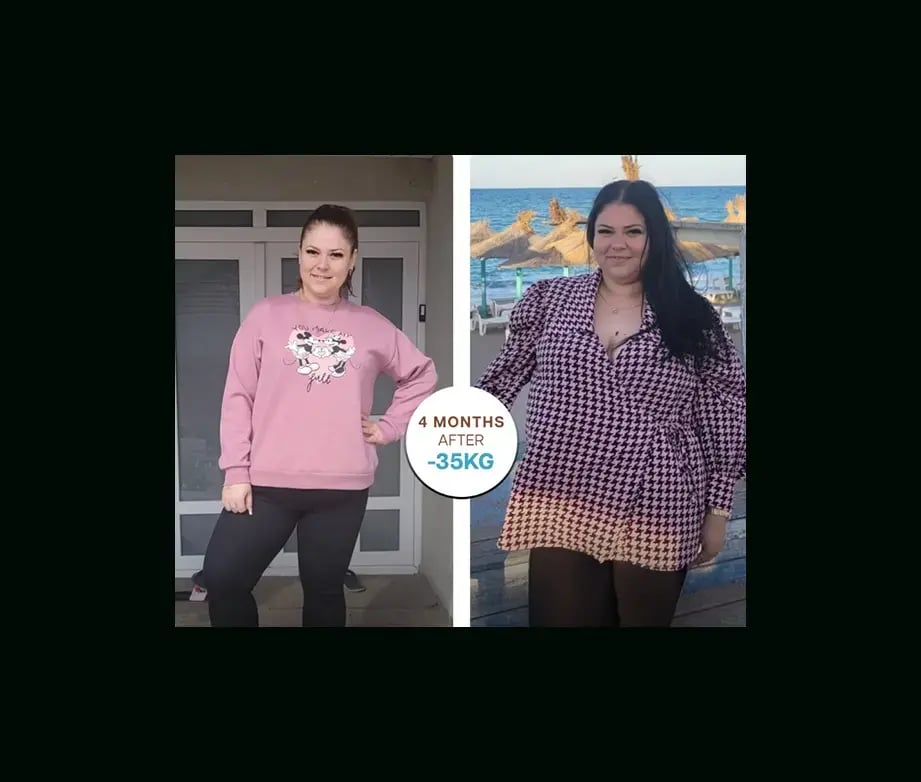 apera-gastric-sleeve-before-after-48