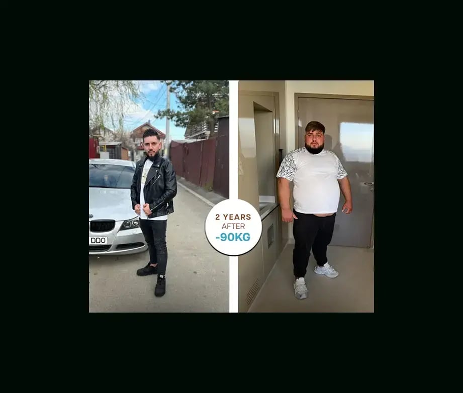 apera-gastric-sleeve-before-after-49