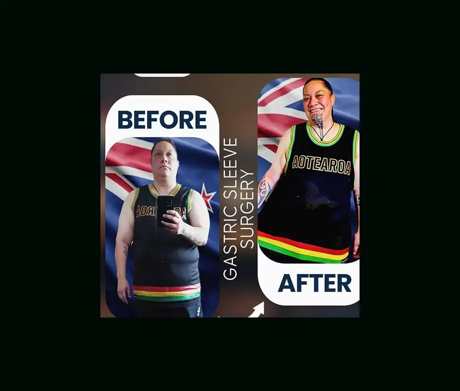 apera-gastric-sleeve-before-after-5