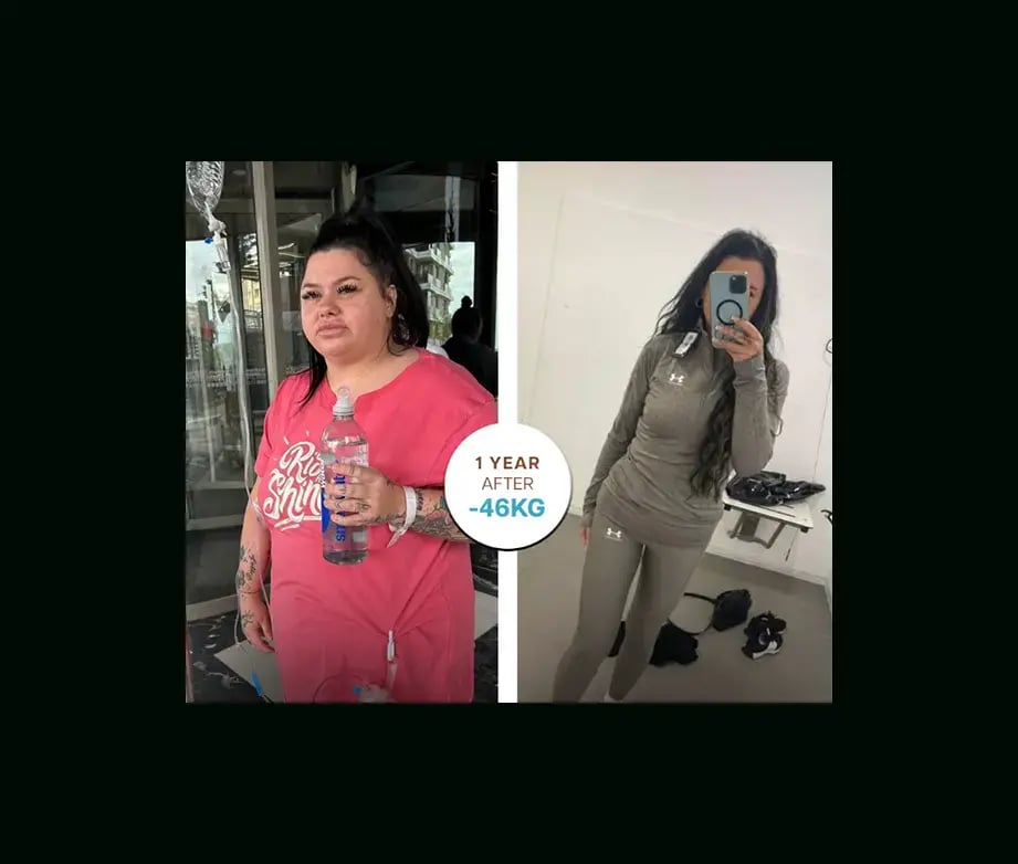 apera-gastric-sleeve-before-after-50