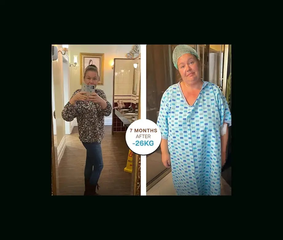 apera-gastric-sleeve-before-after-51