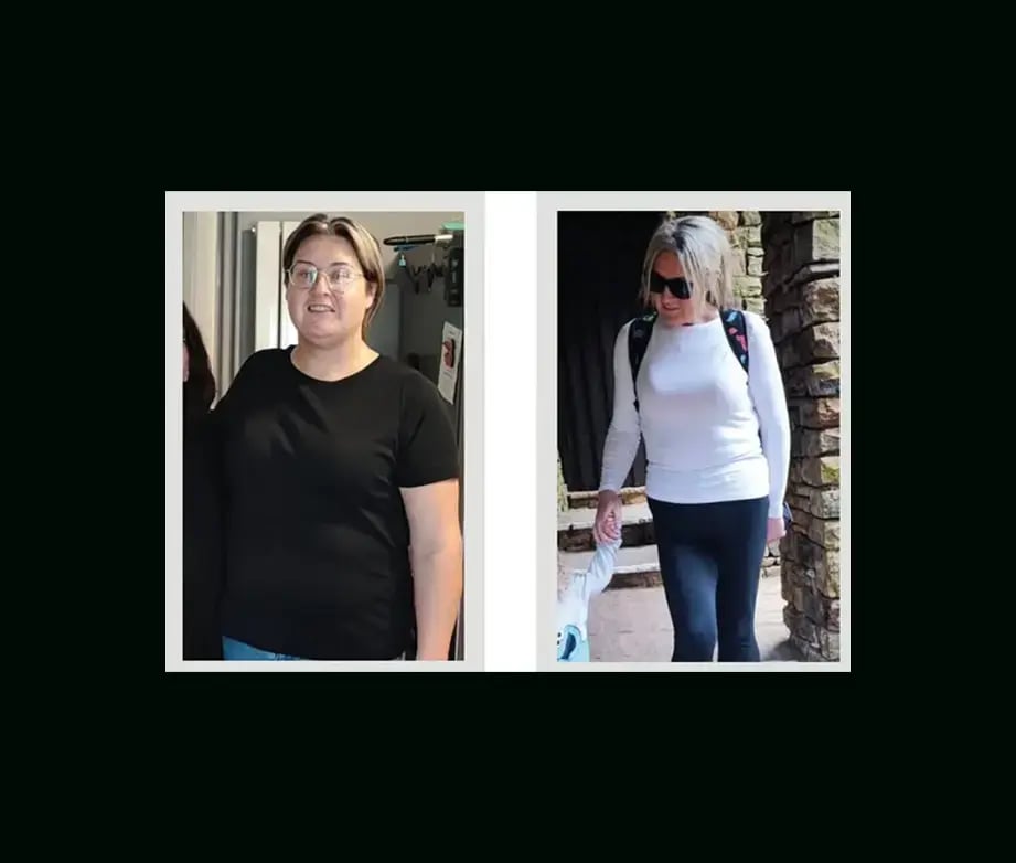 apera-gastric-sleeve-before-after-52